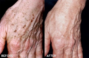 Hand Rejuvenation