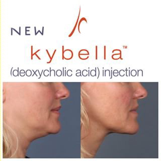 kybella logo for removing  double chin