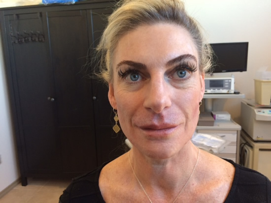 PDO Thread facial procedure results performed at La Fontaine Fusion Spa in Denver Colorado.