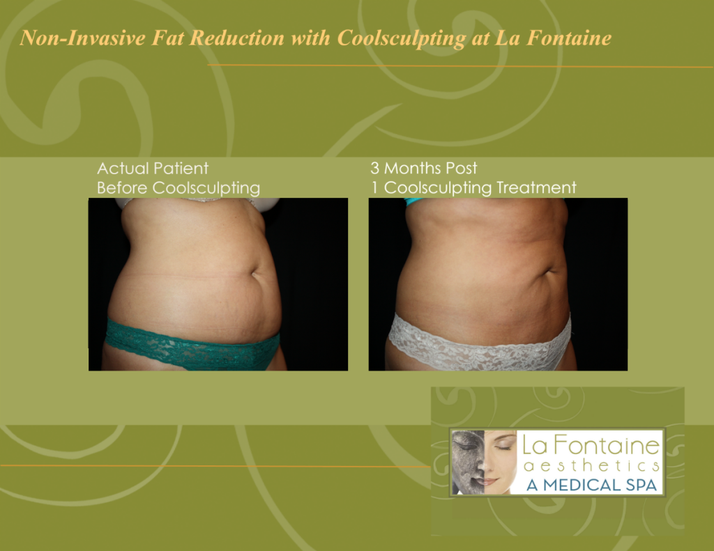 coolsculpting denver, best coolsculpting la fontaine, coolsculpting cherry creek