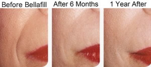 Bellafill Long-Lasting Dermal Filler