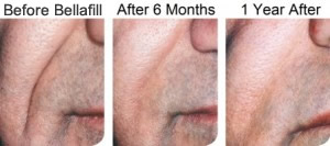 Bellafill Long-Lasting Dermal Filler