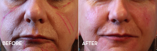 Before and after a liquid facelift in Denver at La Fontaine Aesthetics
