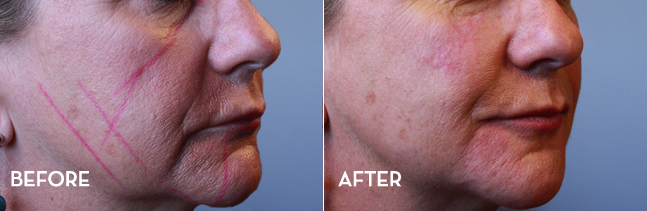 Before and after a non-surgical facelift at La Fontaine Aesthetics in Denver