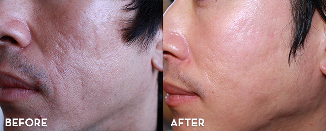 Acne Scar Treatment Results Before and After | La Fontaine Aesthetics