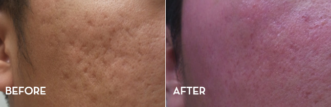 Acne Scar Treatment Results Before and After | La Fontaine Aesthetics