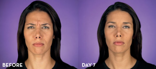 Botox Treatment Before and After | La Fontaine Aesthetics