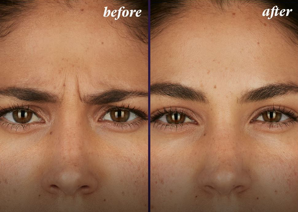 Before and after BOTOX injections in Denver at La Fontaine Aesthetics