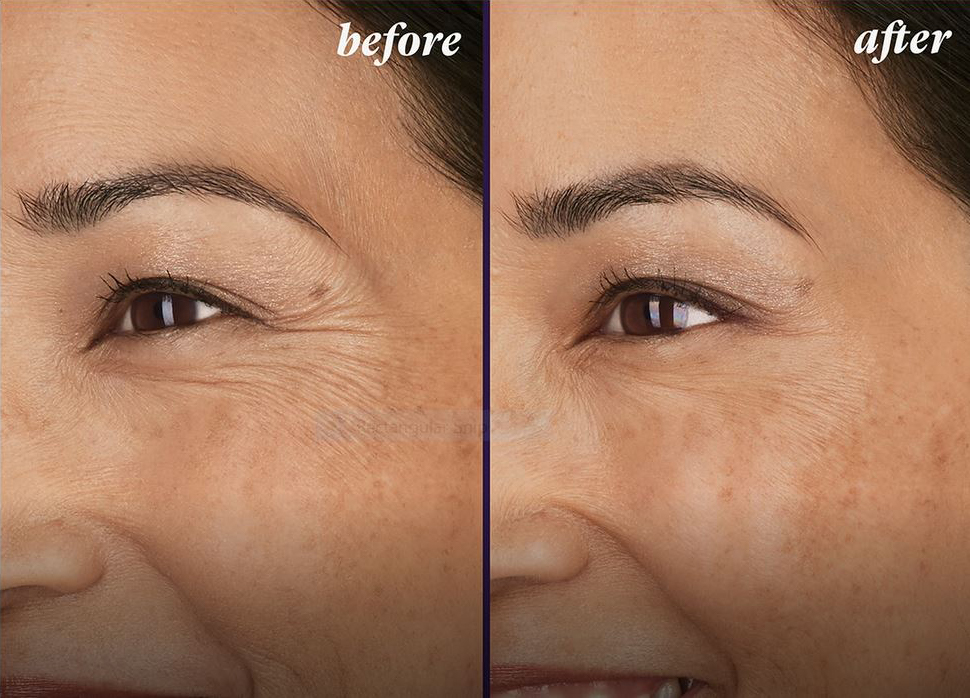 Before and after BOTOX treatment at La Fontaine Aesthetics in Denver