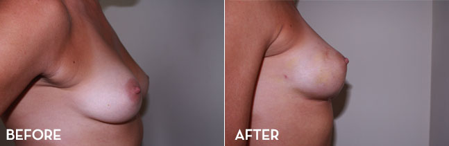 Breast Enhancement Before and After | La Fontaine Aesthetics