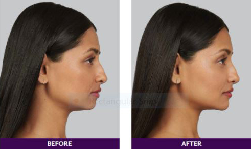 Chin Filler Before and After | La Fontaine Aesthetics