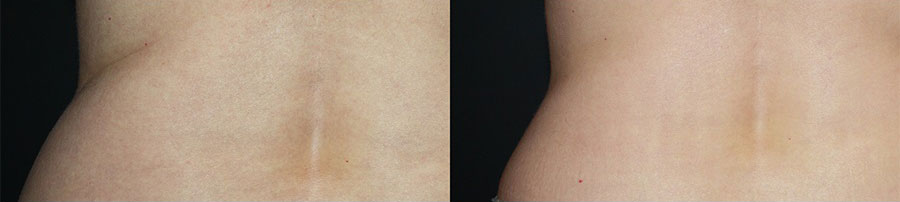 Before and after CoolSculpting in Denver at La Fontaine Aesthetics