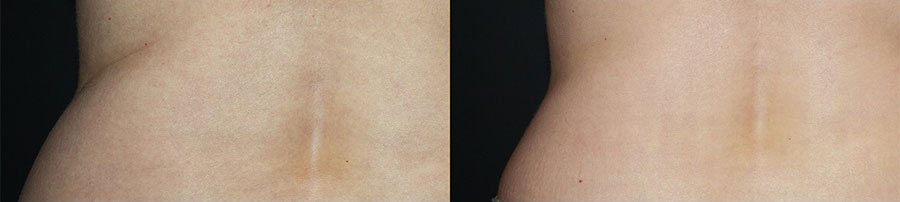 Before and after CoolSculpting in Denver at La Fontaine Aesthetics
