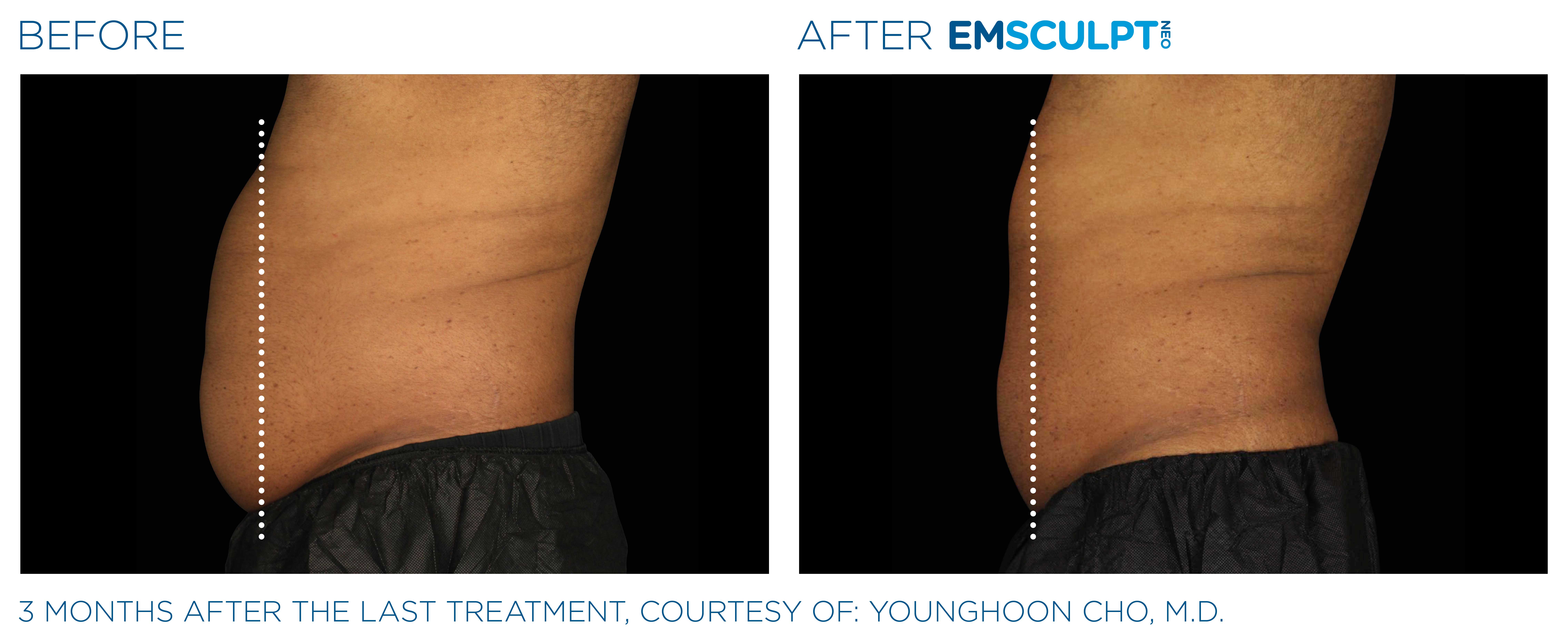 Emsculpt Neo Treatments Before and After | La Fontaine Aesthetics