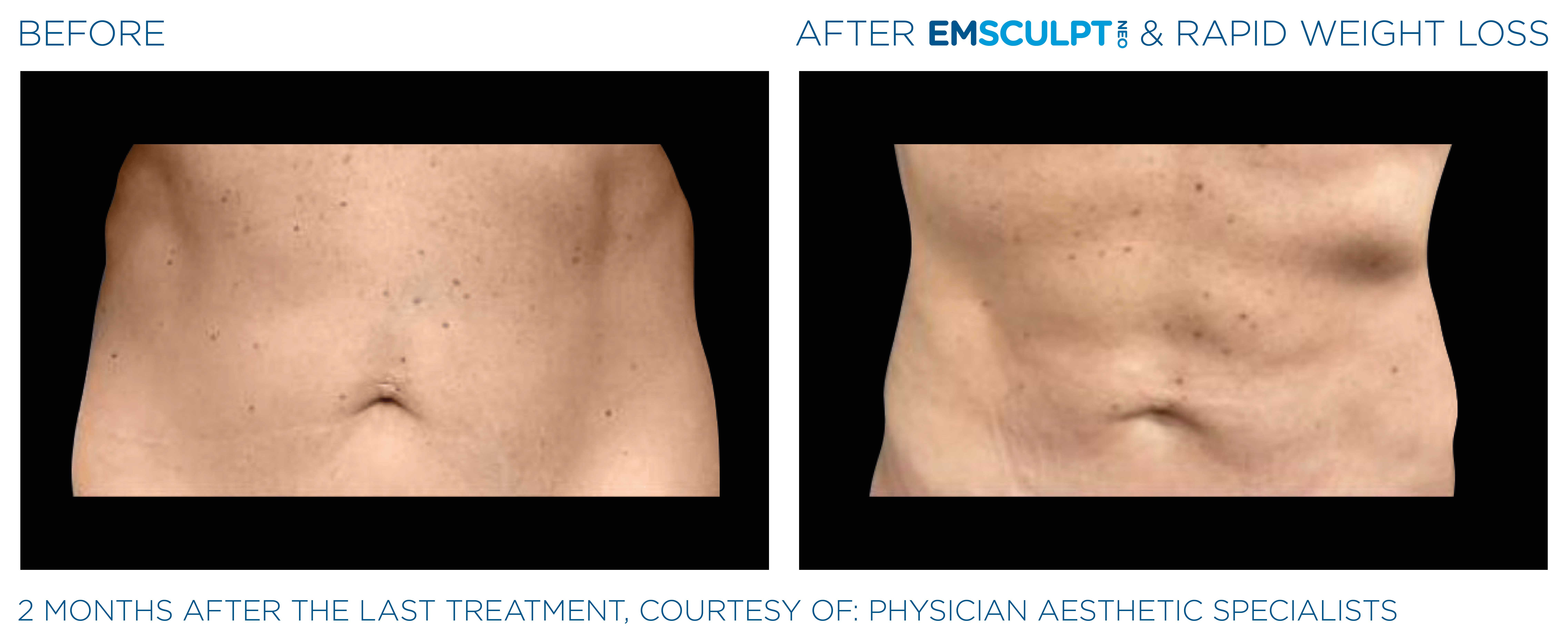 Emsculpt Neo Treatments Before and After | La Fontaine Aesthetics