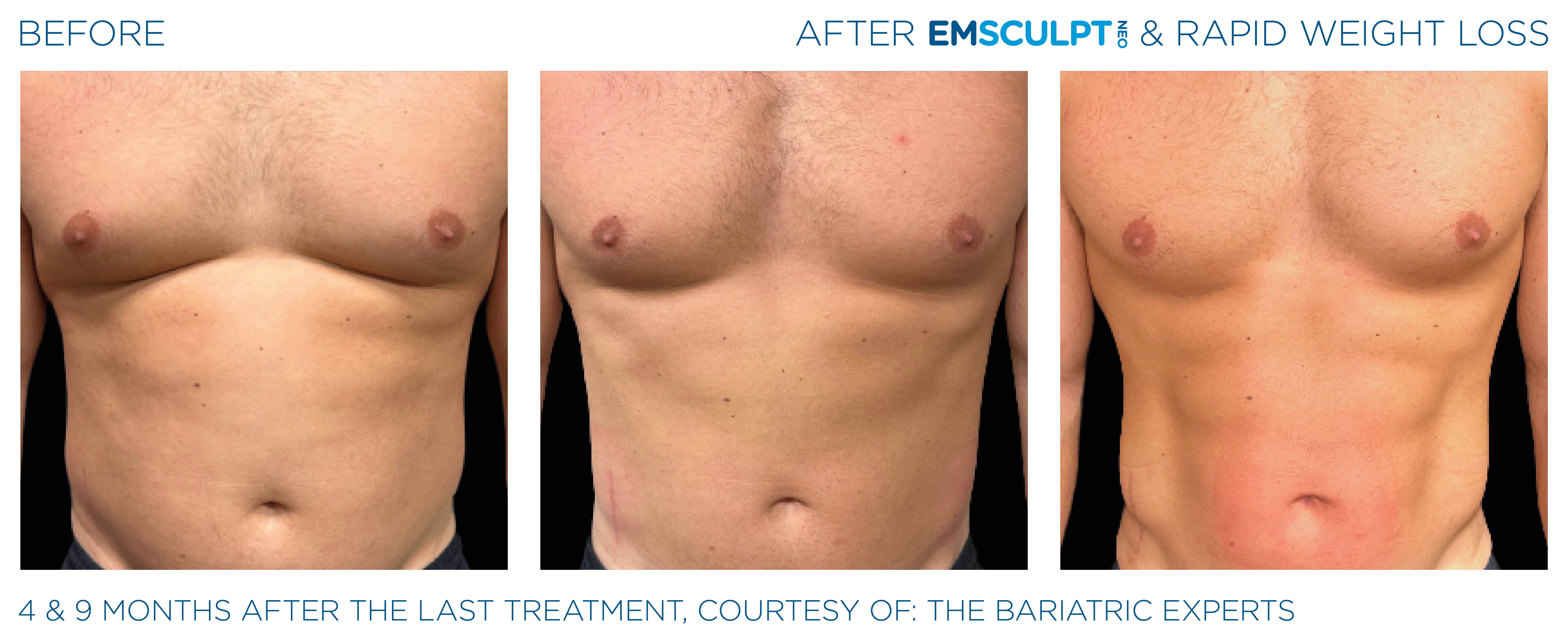 Emsculpt Neo Treatments Before and After | La Fontaine Aesthetics