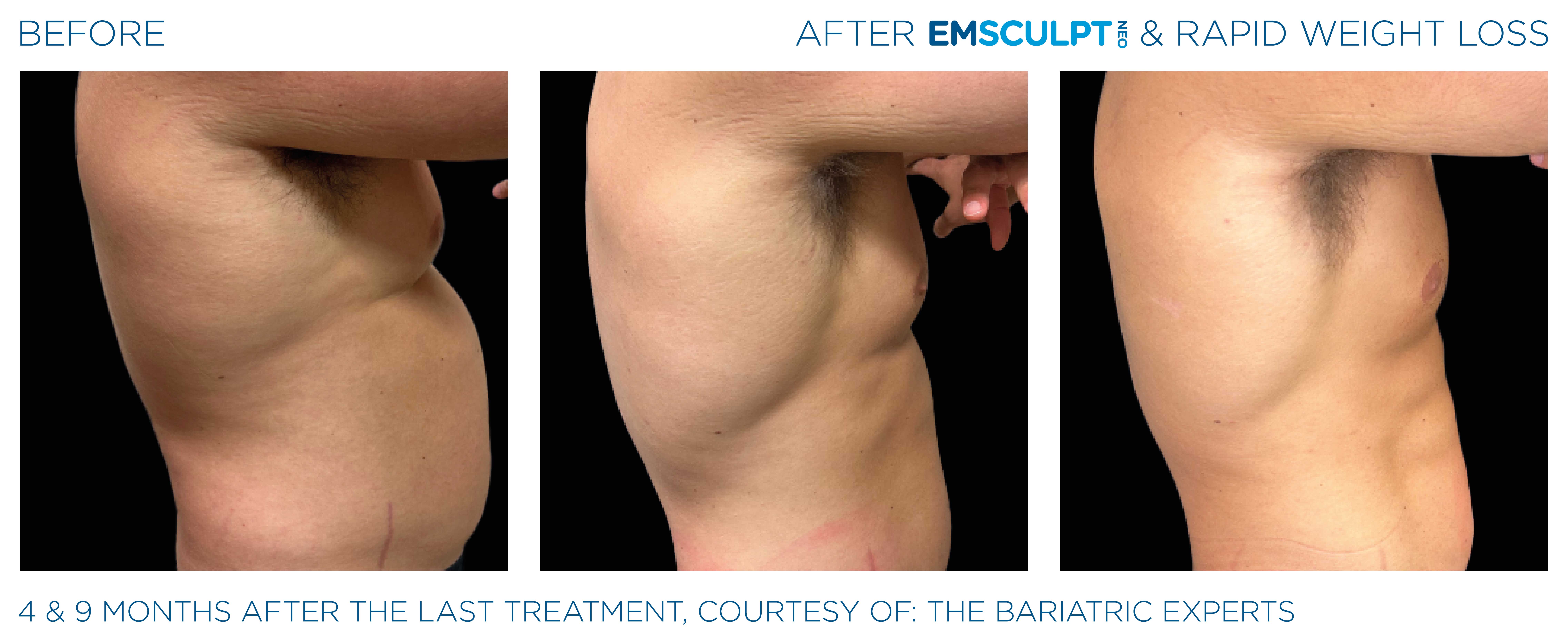 Emsculpt Neo Treatments Before and After | La Fontaine Aesthetics