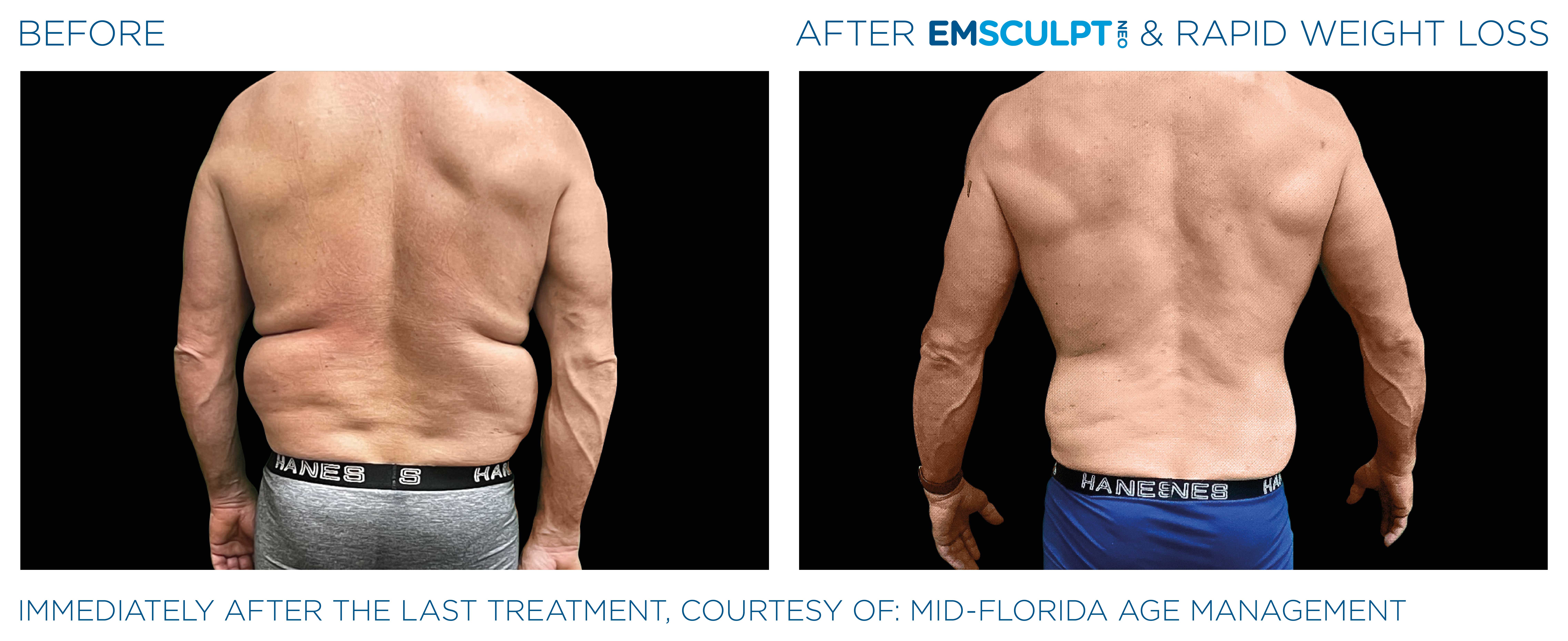 Emsculpt Neo Treatments Before and After | La Fontaine Aesthetics