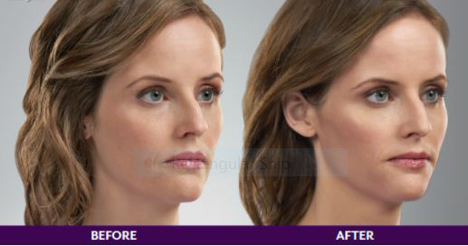 Before and after Juvederm injections in Denver at La Fontaine Aesthetics