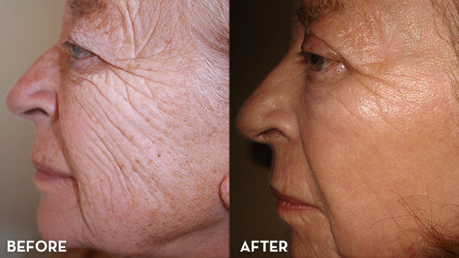 Laser Skin Resurfacing Before and After | La Fontaine Aesthetics