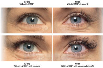 Latisse Before and After | La Fontaine Aesthetics