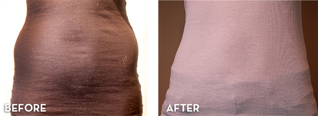 Liposuction Treatment Results Before and After | La Fontaine Aesthetics