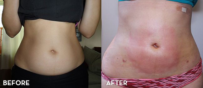 Liposuction Treatment Results Before and After | La Fontaine Aesthetics
