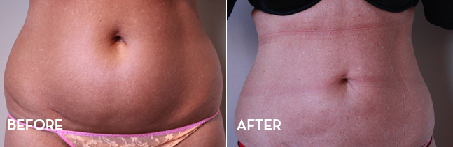 Liposuction Treatment Results Before and After | La Fontaine Aesthetics