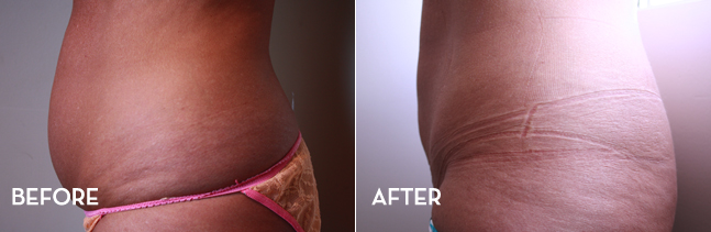 Liposuction Treatment Results Before and After | La Fontaine Aesthetics