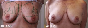 Natural Breast Enhancement Before and After | La Fontaine Aesthetics