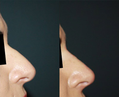 Non Surgical Rhinoplasty Before and After | La Fontaine Aesthetics