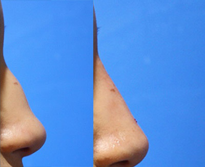 Non Surgical Rhinoplasty Before and After | La Fontaine Aesthetics