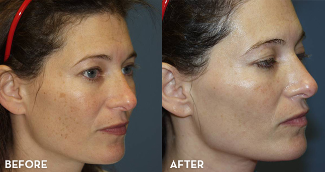 Photofacial Treatment Results Before and After | La Fontaine Aesthetics