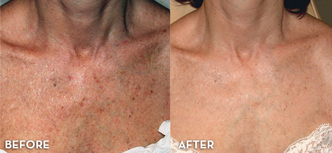 Photofacial Treatment Results Before and After | La Fontaine Aesthetics