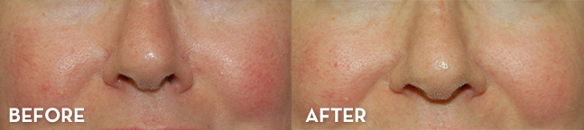 Rosacea Treatment Results Before and After | La Fontaine Aesthetics