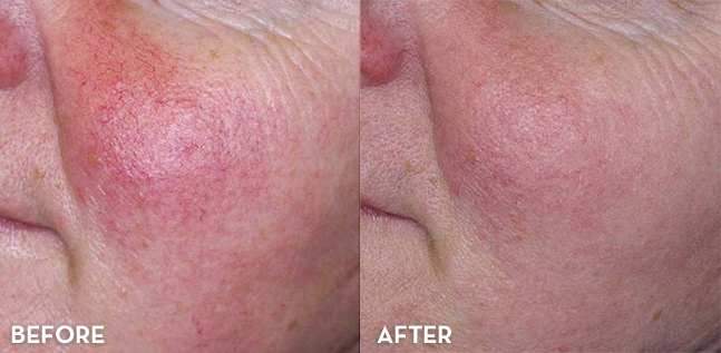 Rosacea Treatment Results Before and After | La Fontaine Aesthetics
