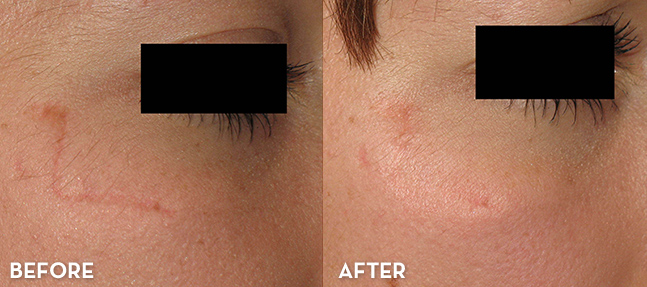 Scar Treatment Results Before and After | La Fontaine Aesthetics