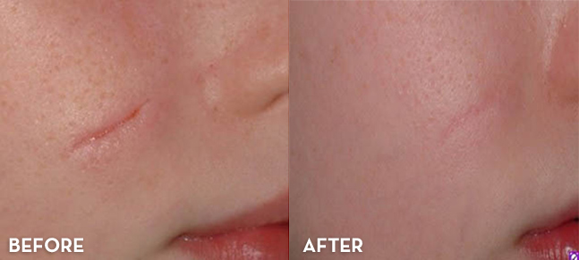 Scar Treatment Results Before and After | La Fontaine Aesthetics