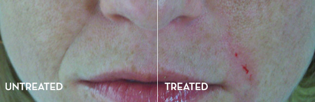 Smile Lines Before and After | La Fontaine Aesthetics