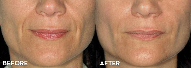 Smile Lines Before and After | La Fontaine Aesthetics