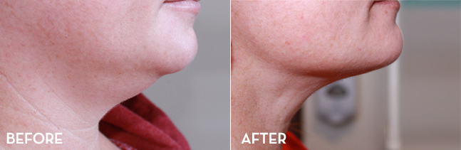 Under Chin Fat Removal Before and After | La Fontaine Aesthetics