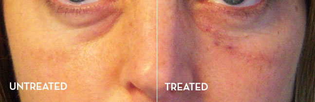 Under Eye Treatment Results Before and After | La Fontaine Aesthetics