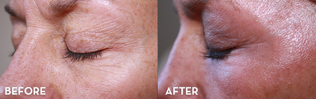 Under Eye Treatment Results Before and After | La Fontaine Aesthetics