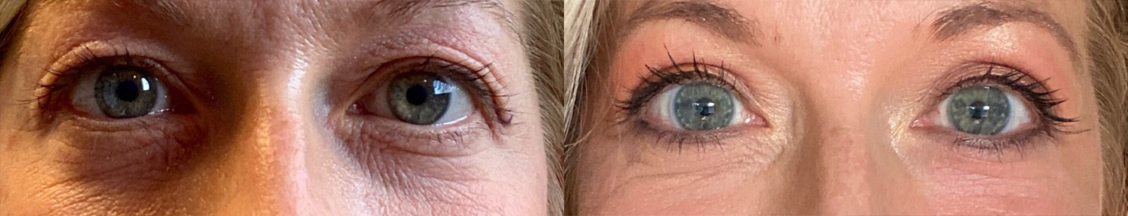 Upper Blepharoplasty Before and After | La Fontaine Aesthetics