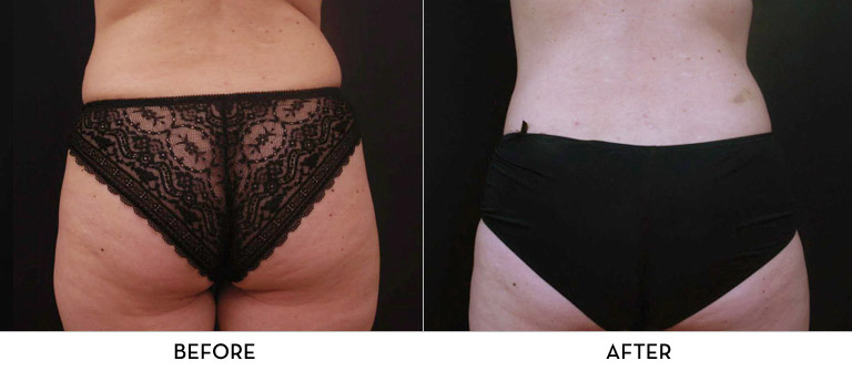 Vanquish Before Afters Before and After | La Fontaine Aesthetics