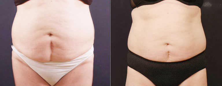 Vanquish Before Afters Before and After | La Fontaine Aesthetics