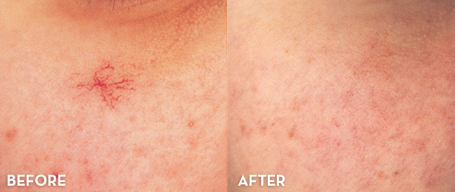 Vein Treatment Results Face Before and After | La Fontaine Aesthetics