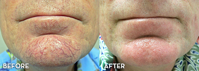 Vein Treatment Results Face Before and After | La Fontaine Aesthetics