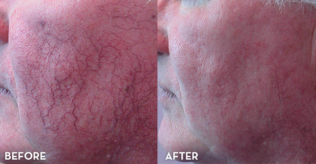 Vein Treatment Results Face Before and After | La Fontaine Aesthetics