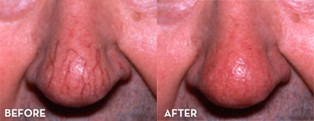 Vein Treatment Results Face Before and After | La Fontaine Aesthetics